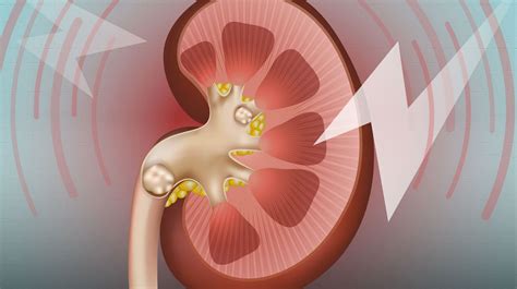 kidney stones  marker   kidney health news uab