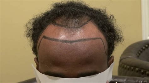 Black Man Hair Transplant Lower Hair Line For Balding
