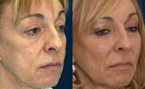 Facial Fat Injections Before And After Photos For Thinning
