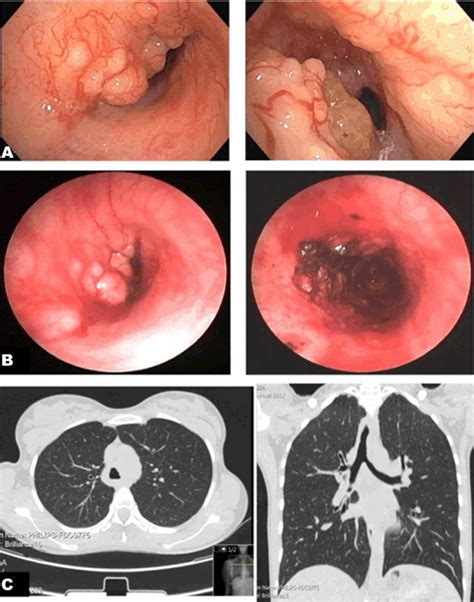 Full Text Tracheal Adenoid Cystic Carcinoma A Case Report