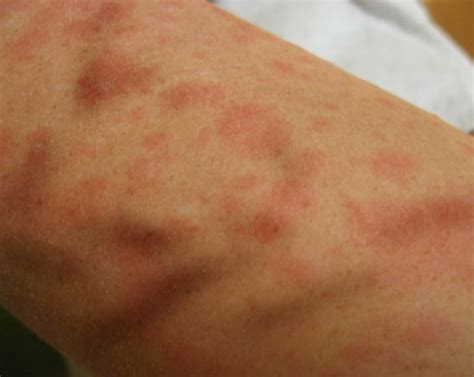 itchy skin rash pictures  symptoms treatment hubpages
