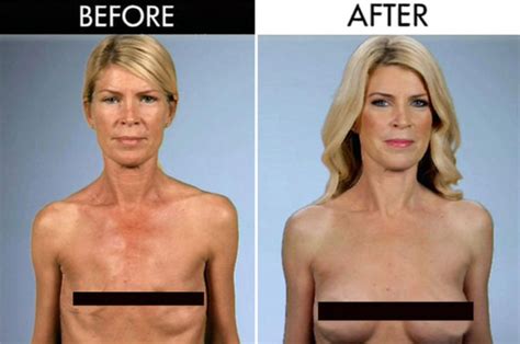 Plastic Surgery Disaster Leaves Woman With Two Sunken Holes For Boobs