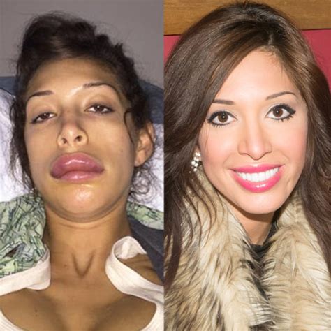 were farrah abraham s botched lip injections magically fixed e