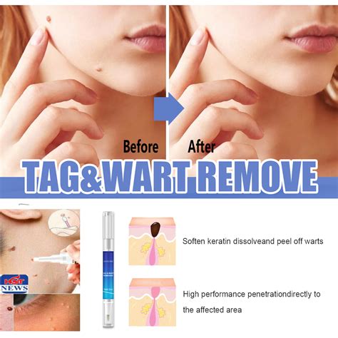 1pc 6ml body wart treatment papillomas removal of warts liquid from