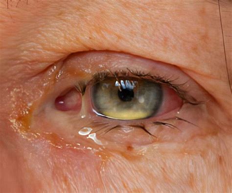 eye infections   eye infections