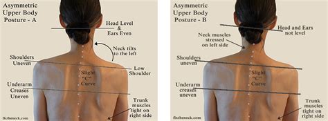 Overcoming Chronic Neck Pain Postural Causes And A Unique