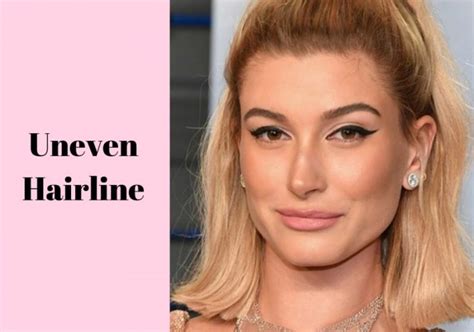9 Different Types Of Hairlines Low Uneven High Receding And More