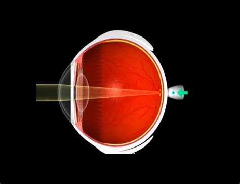 astigmatism vision infinity optometrist