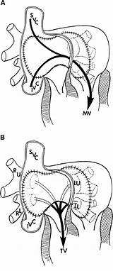 Arteries Transposition Atrial Ahajournals sketch template