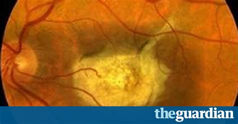 stem cell therapy success in treatment of sight loss from macular