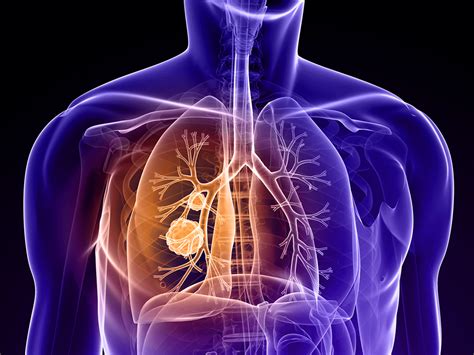 lipid metabolism controls lung cancer metastasis   diseases