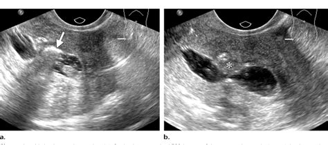 figure 15 from saline infused sonohysterography tips for achieving