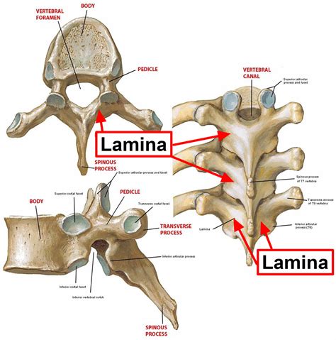 laminectomy surgery recovery laminectomy complications