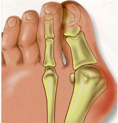 bunion surgery midtown downtown ny gotham footcare
