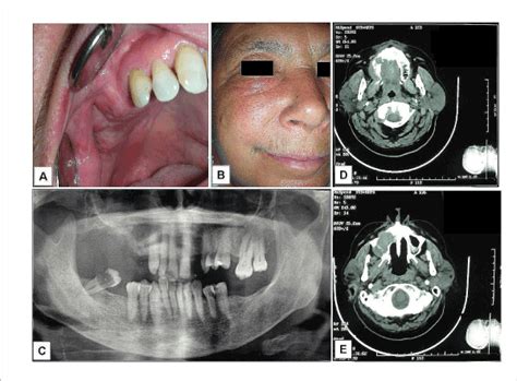 maxillary sinus cancer pictures cancerwalls