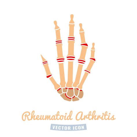 Rheumatoid Arthritis In Hands Drawings Illustrations