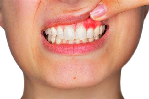 home remedies  inflamed gums  practical tips