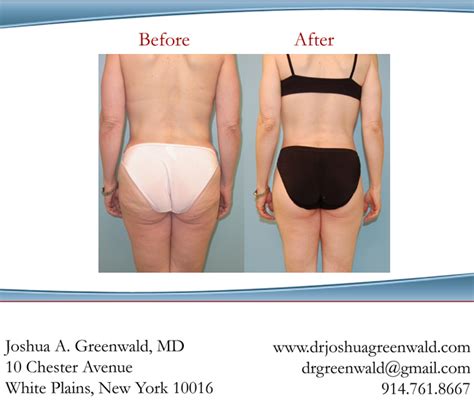 Before After Lower Body Lift New York Westchester County