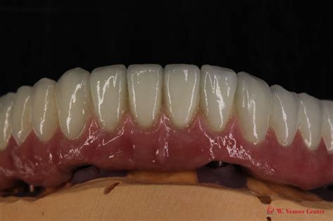 maxillary  mandibular incisors  veneer center