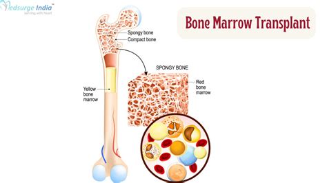bone marrow transplant  delhi cost medsurge india