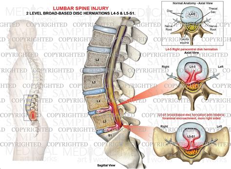 level     lumbar disc herniations medical art works