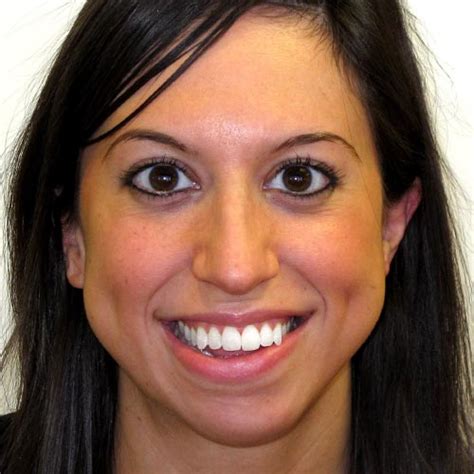 before and after adult braces team orthodontics