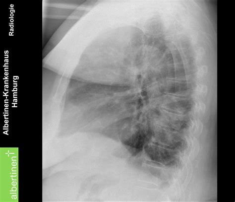 roe thorax bronchopneumonie bds seitl doccheck