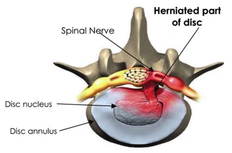 treatment    pain lumbar spine pain disc injury disc