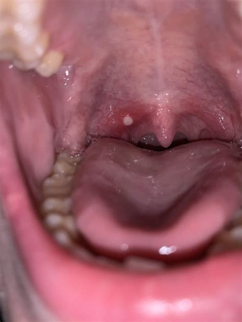 white painful sore    throat rdiagnoseme