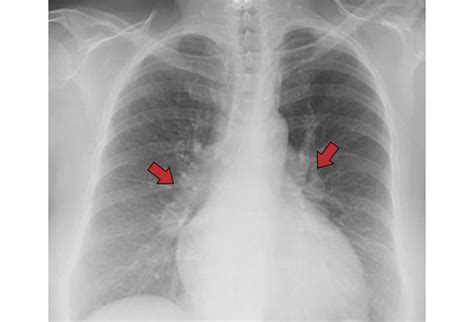Chest X Rays 16 Subtle But Key Findings You Need To Know