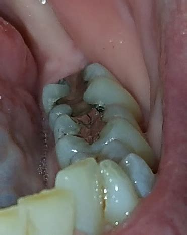 prevention  home remedies  tonsil stones cure