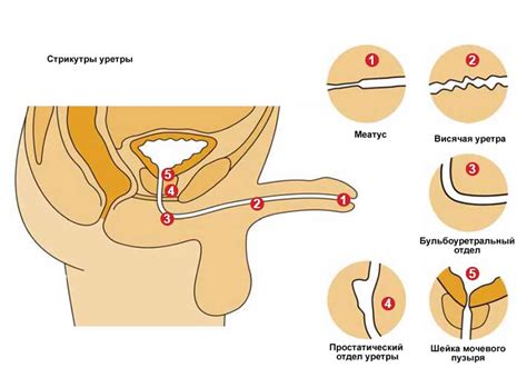 Стриктура уретры у мужчин и женщин лечение причины симптомы
