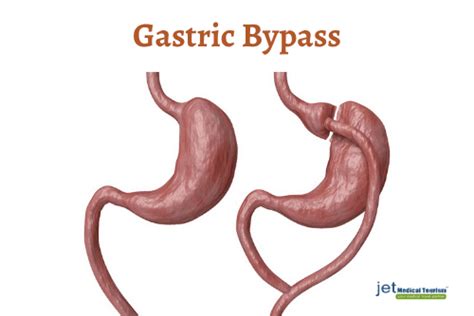 Gastric Sleeve Vs Bypass Vs Lap Band Which Is Best Weight