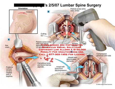 Amicus Illustration Of Amicus Surgery Lumbar Spine Fusion