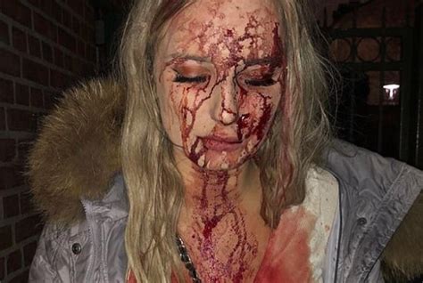 shocking photos swedish girl attacked with bottle after
