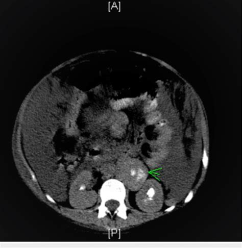 Ct Scan Of The Abdomen With The Enlarged Retroperitoneal Lymph Nodes