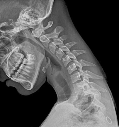 cervical radiculopathy pinched nerve disc herniation bone spurs