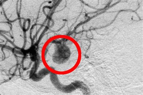 aneurysma den geraeuschlosen killer spuert der mensch nicht die welt