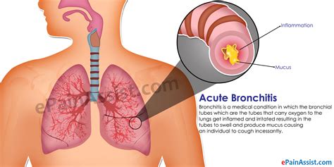 acute bronchitis treatment home remedies prevention symptoms