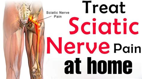 Pin On Sciatic Nerve Pain