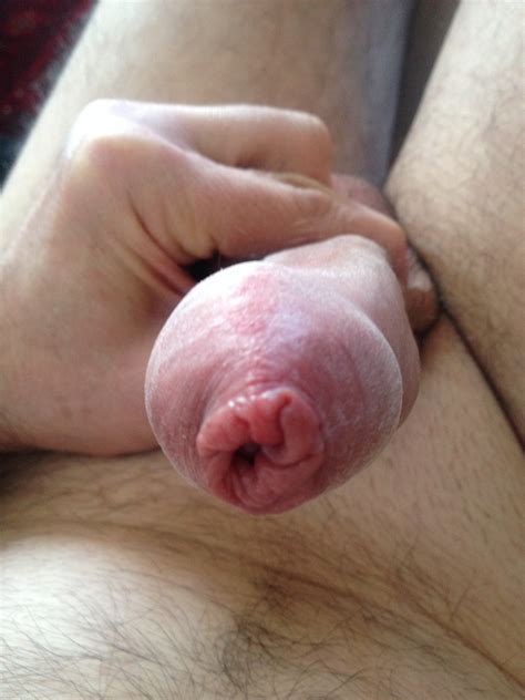 foreskin too tight