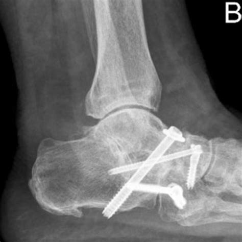 ankle triple arthrodesis ballaratosm ballarat orthopaedics sports