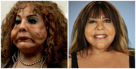 extreme plastic surgery transformations  botched