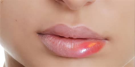 How To Treat Swollen Lips Causes Cures And Prevention