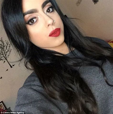 Vitiligo Sufferer Ashley Soto Who Hid Her Body For Years Showing Her