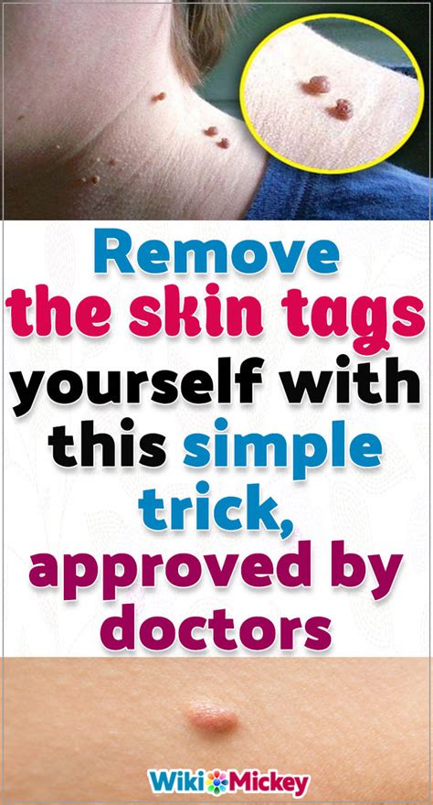 home remedies to remove skin tags with apple cider vinegar
