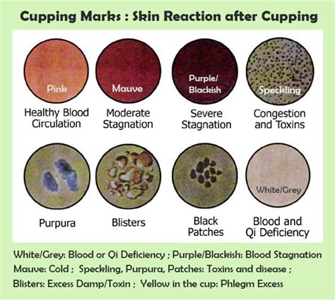 cupping therapy  healing point acu center