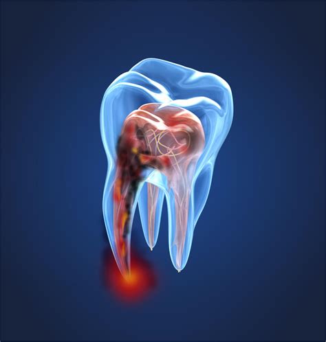 understanding  facts   tooth nerve infection veinscnycom
