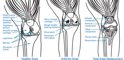 Knee Replacement Surgery Procedure Types And Risks Hss