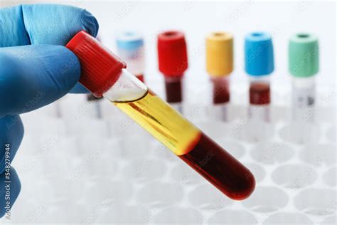 blood drawn   patient  serum separate   chemistry